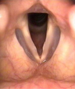 Vocal-Fold-Nodules