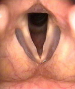 Vocal Fold Nodules MICRO LARYNEAL SURGERY​