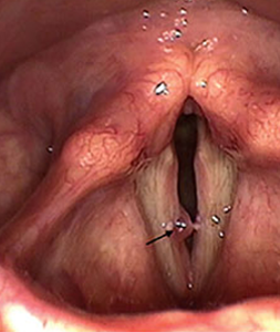Throat-Bilateral-cysts