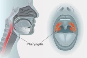 Throat Pharyngitis