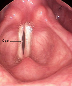 Vocal-Fold-Cysts