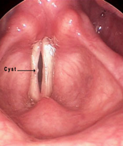 Vocal Fold Cysts