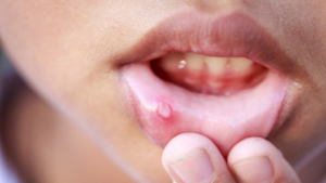 Throat-Aphthous-Ulcer-2