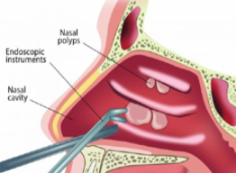 What-Are-Nasal-Polyps